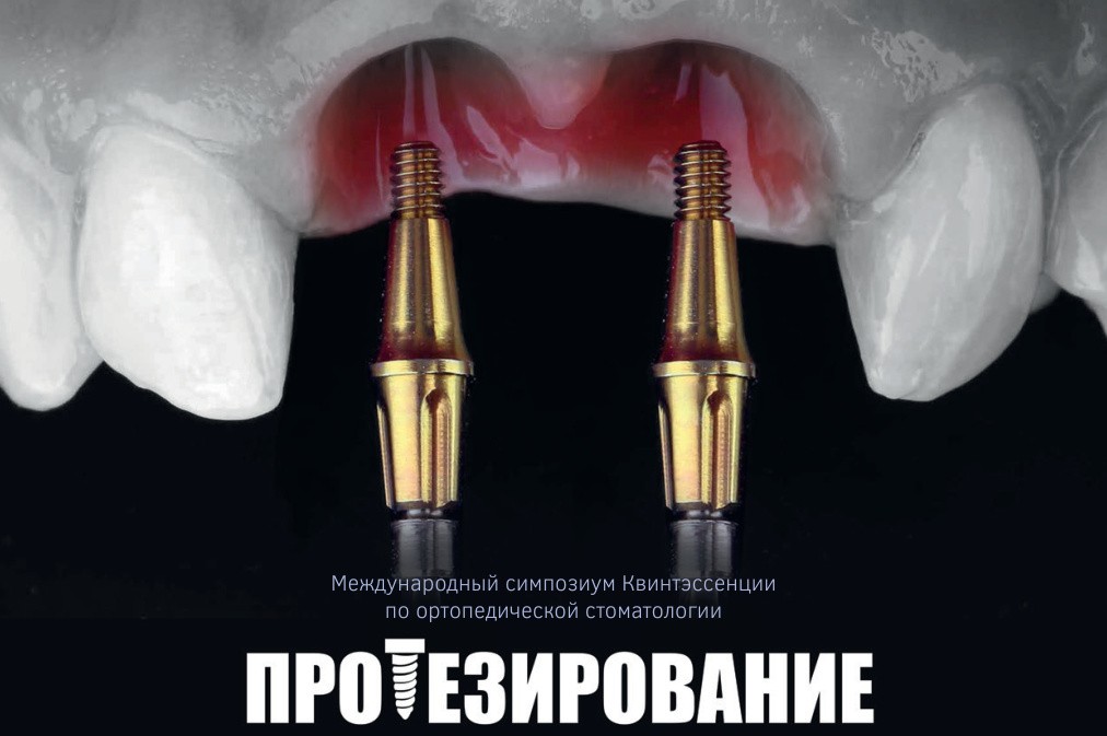 Протезирование с опорой на имплантаты